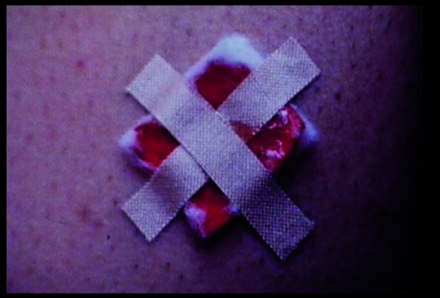 Descrição da imagem: Fotografia na vertical. gaze quadrada com mancha de sangue sobre a pele, fixada por duas fitas de esparadrapo em formato de X. Fim da descrição. 
